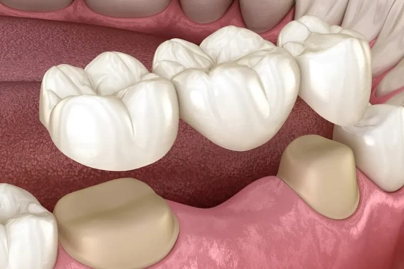 dental_bridges_after_care_image