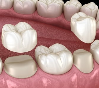 Dental Crowns in Melbourne