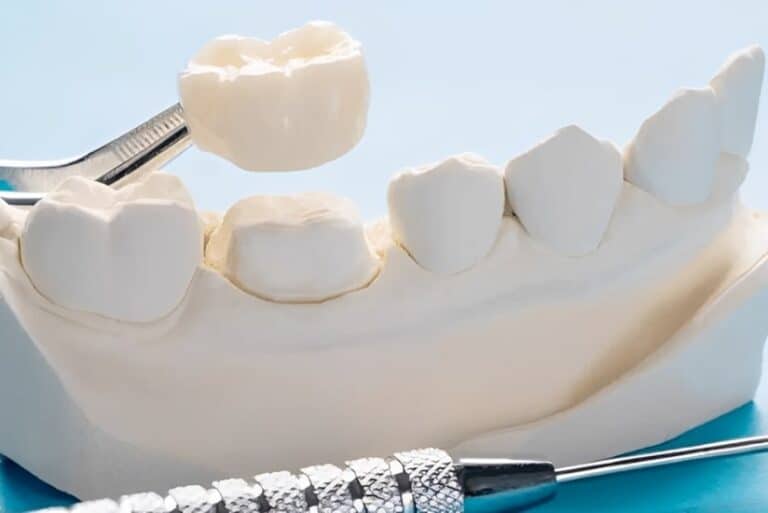 Dental Crowns in Melbourne