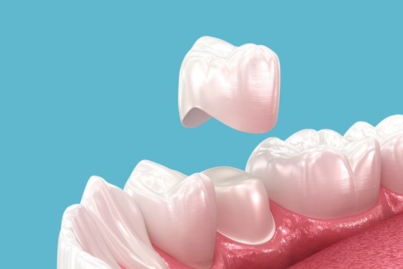 Dental Crowns in Melbourne