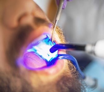 dental_fillings_benefits_card_1_image