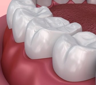 dental_fillings_benefits_card_1_image
