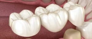 dental_bridges_after_care_image