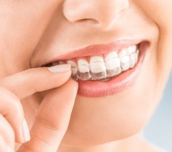 img_feature_invisalign_clear_aligners