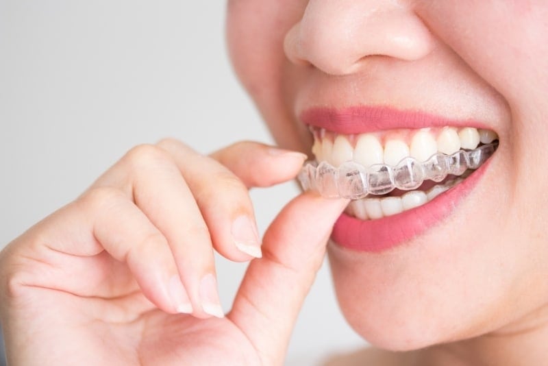 img_feature_invisalign_clear_aligners