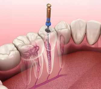 img_feature_root_canal