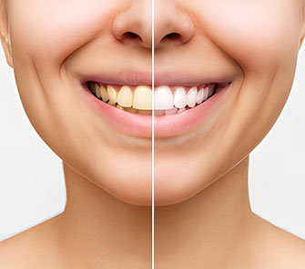 teeth_whitening_benefits_card_1_image_V3