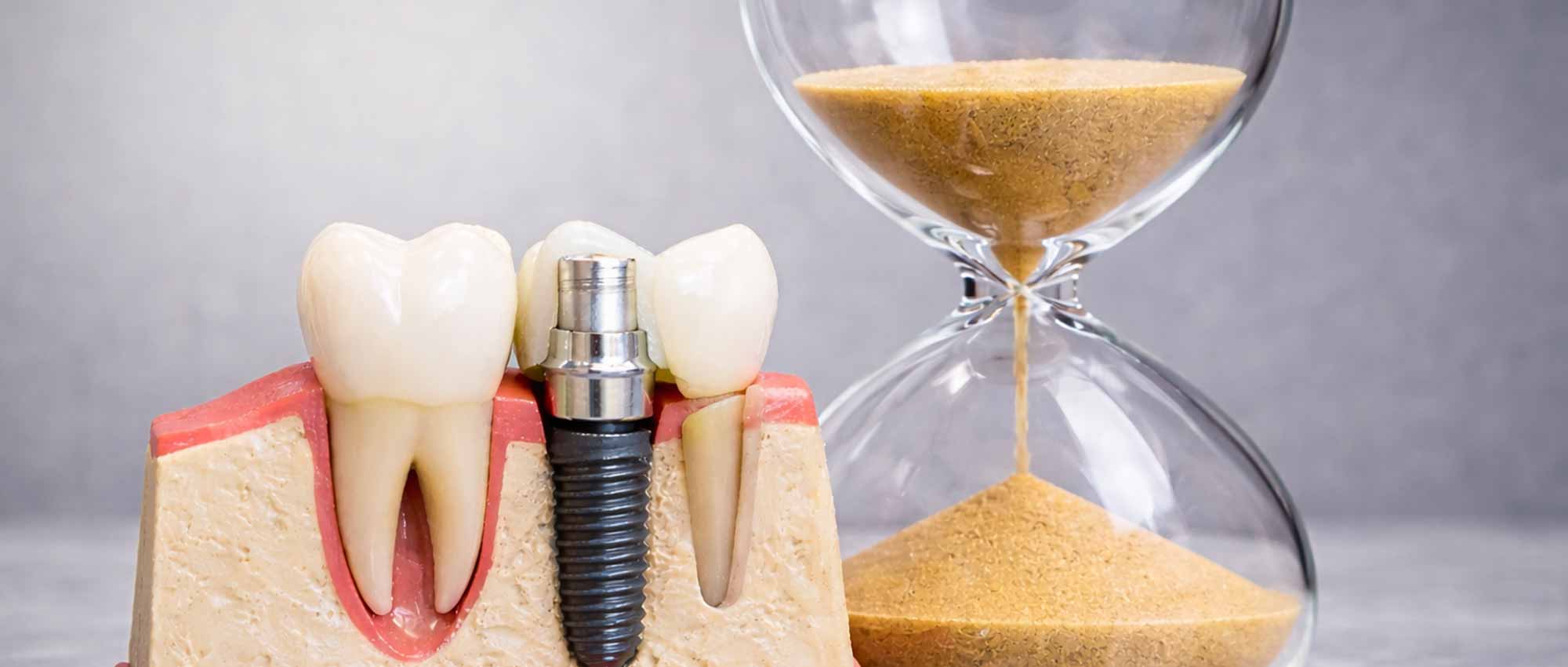 img_feature_how_long_do_dental_implants_last