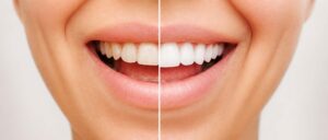 img_feature_guide-to-porcelain-veneers