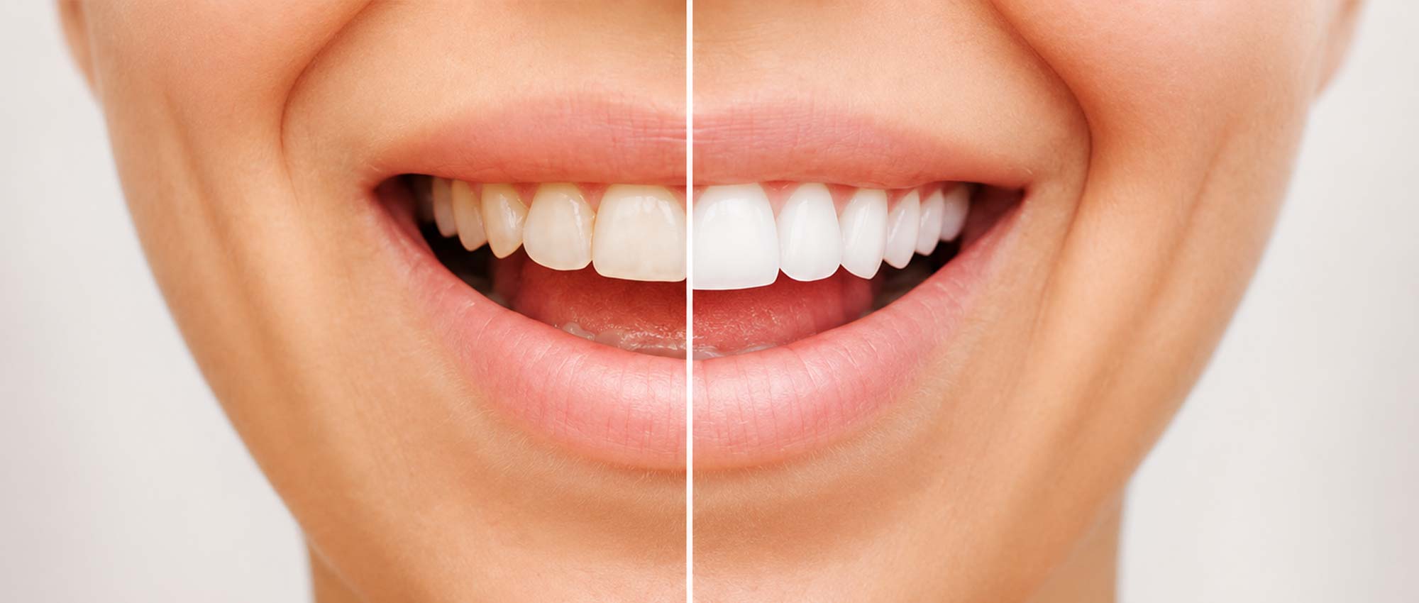 img_feature_guide-to-porcelain-veneers